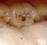 Причини за разрушаване емайла на зъбите